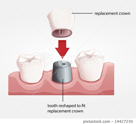 Dental crown procedure Dental crown procedure 14427230