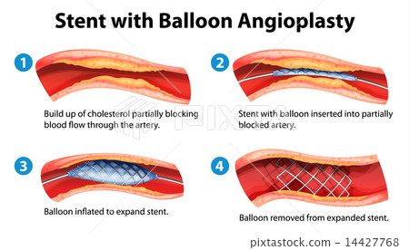 Stent angioplasty procedure 14427768