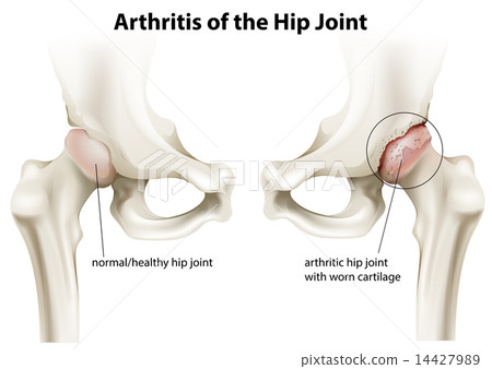 Arthritis of the hip joint 14427989