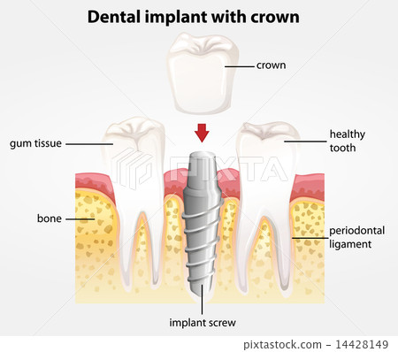 Dental implant with crown Dental implant with crown 14428149
