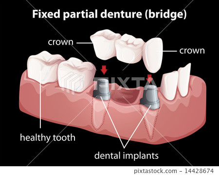 A fixed partial denture 14428674