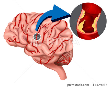 Blood Clot concept in the brain 14429013