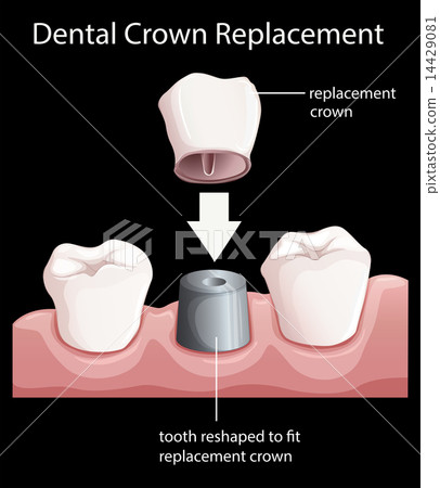A dental crown replacement 14429081