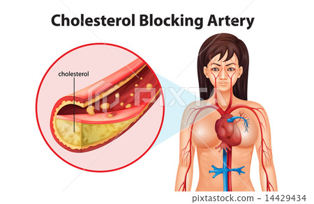 Ateriosclerosis 14429434