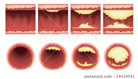 Ateriosclerosis Ateriosclerosis 14429541