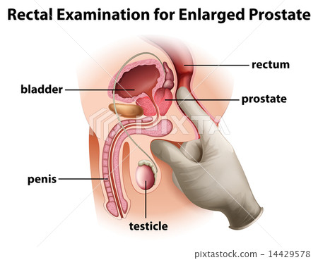 a prostatitis- betegség jelei férfiakban)