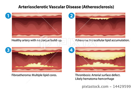 Ateriosclerosis 14429599