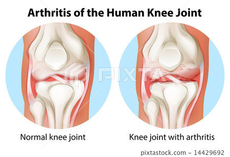 Arthritis of the human knee joint 14429692