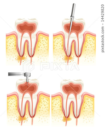 Dental root canal 14429820