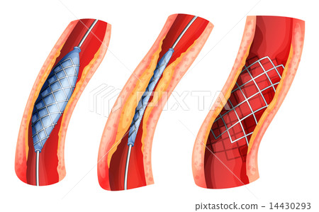 Stent used to open blocked artery 14430293