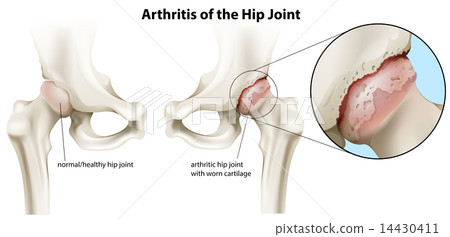 Arthritis of the hip joint 14430411