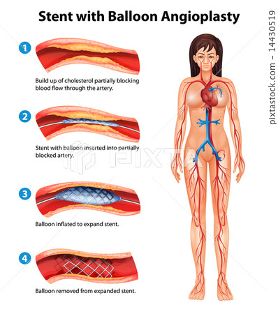 Stent angioplasty procedure Stent angioplasty procedure 14430519