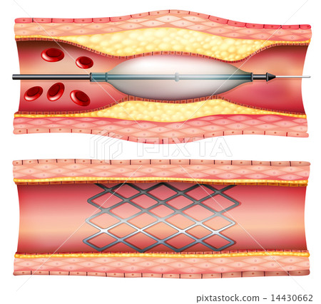 Stent Angioplasty 14430662