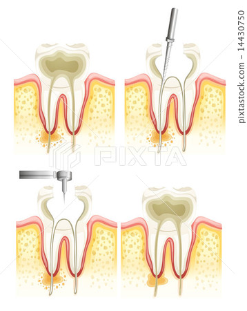 Root canal process 14430750