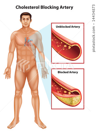 Ateriosclerosis Ateriosclerosis 14434873