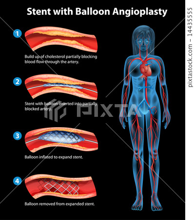 Stent angioplasty procedure 14435555