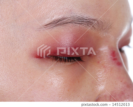 close-up of upper eye lid swell after nose job 14512013