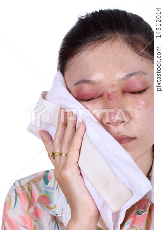 Woman holds an ice pack after nose job 14512014
