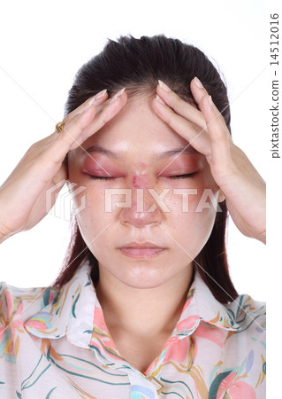 woman with nose and eye swelll after nose job 14512016