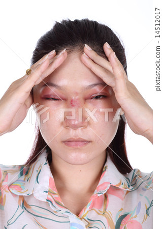 woman with nose and eye swelll after nose job 14512017