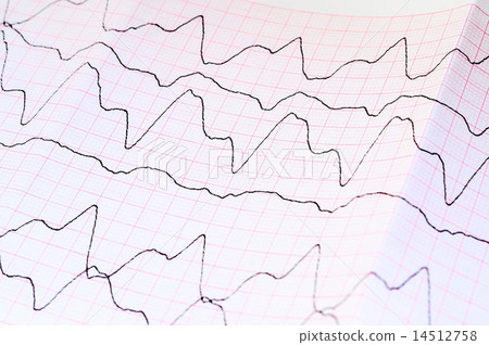 ECG tape with paroxysmal ventricular tachycardia 14512758