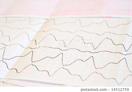 ECG tape with paroxysmal ventricular tachycardia 14512759