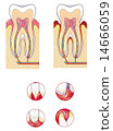 Periodontal disease 14666059