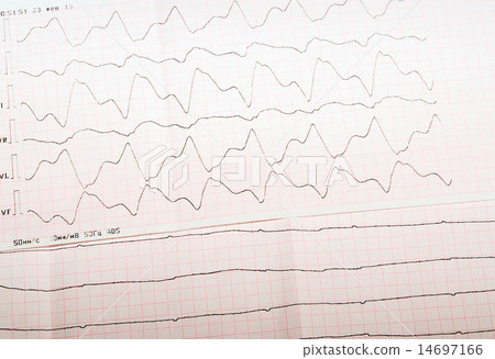 ECG tape with paroxysmal ventricular tachycardia  14697166