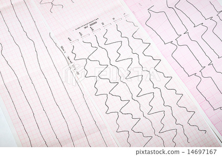 Three tape ECG with acute coronary pathology Three tape ECG with acute coronary pathology 14697167