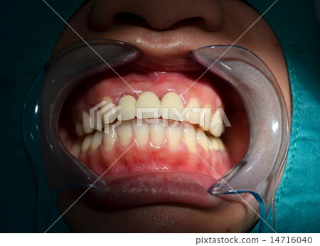 All ceramic bridge of anterior upper teeth 14716040