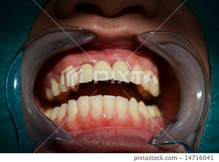 All ceramic bridge of anterior upper teeth All ceramic bridge of anterior upper teeth 14716041