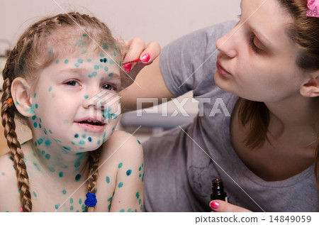 Mom misses zelenkoj rash on face of child with chickenpox 14849059