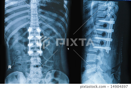 spinal column with implant fusion 14984897