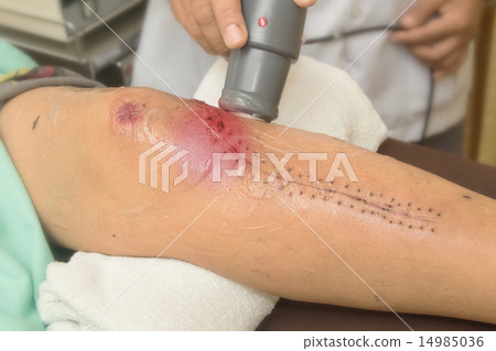 Physiotherapist treats knee surgery wound 14985036
