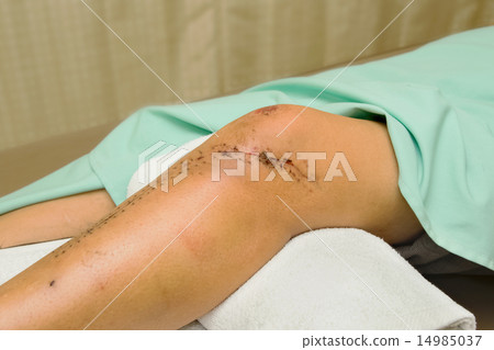 Stitched wound after a surgical knee and leg 14985037
