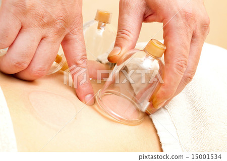  拔罐療法亞洲拔罐療法亞洲 15001534