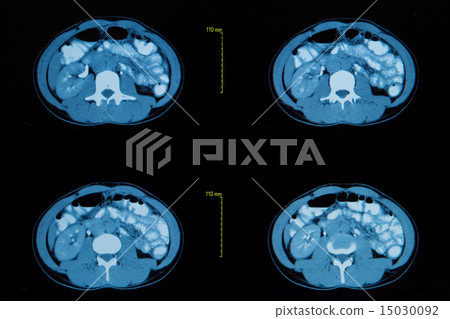 computed tomography of the chest computed tomography of the chest 15030092