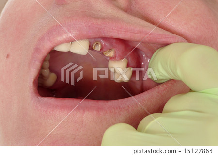 Dental, broken teeth 15127863