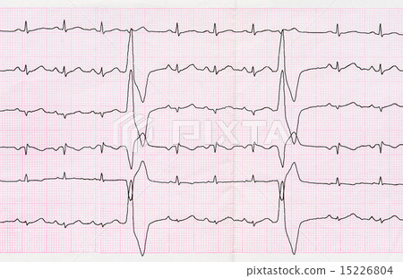 Tape ECG with ventricular premature beats Tape ECG with ventricular premature beats 15226804