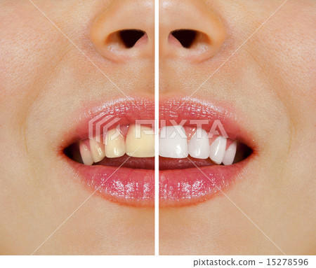 teeth before and after whitening 15278596