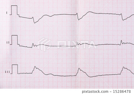 Tape ECG after successful resuscitation Tape ECG after successful resuscitation 15286478