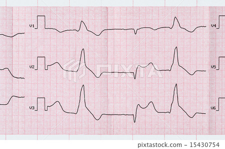 Tape ECG with macrofocal myocardial infarction Tape ECG with macrofocal myocardial infarction 15430754