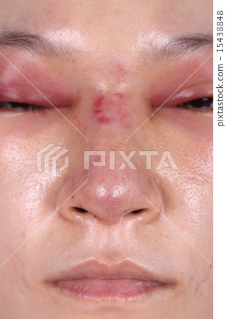 nose and eye swelll after nose job 15438848