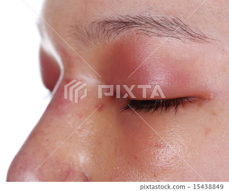 close-up of upper eye lid swell after nose job 15438849