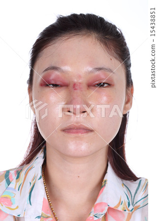 woman with nose and eye swelll after nose job woman with nose and eye swelll after nose job 15438851