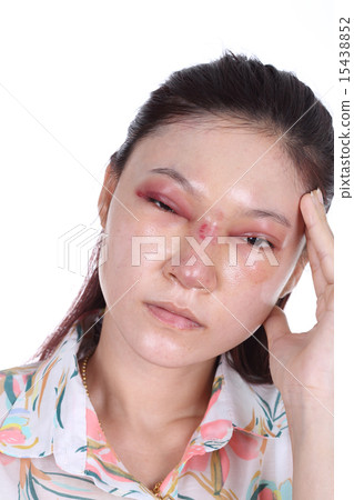 woman with nose and eye swelll after nose job 15438852