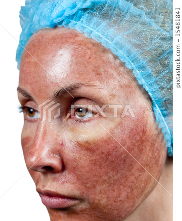 Cosmetology. Skin condition after chemical peeling Cosmetology. Skin condition after chemical peeling 15481841