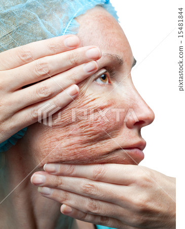 Cosmetology. Chemical peeling. "Parchment" skin Cosmetology. Chemical peeling. "Parchment" skin 15481844