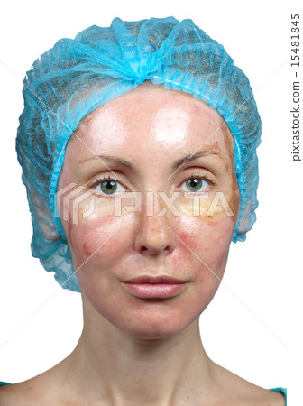Cosmetology. New skin after a chemical peeling, Cosmetology. New skin after a chemical peeling, 15481845