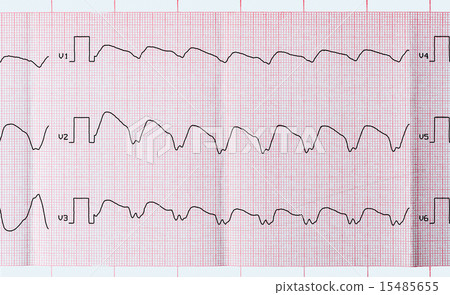 Tape ECG with paroxysmal ventricular tachycardia 15485655